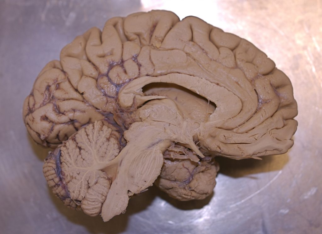 A photograph of a dissection of the human brain on a metal surface.