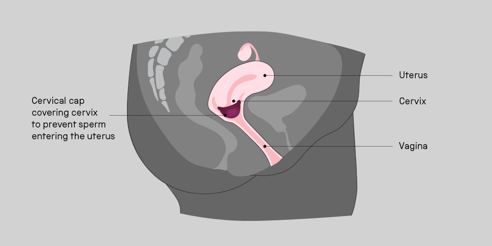 An illustration of how a contraceptive cap works. Inserted into the vagina, the cap covers the cervix to prevent sperm entering the uterus. 